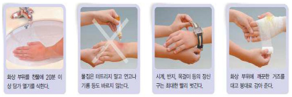 화상 부위를 찬물에 20분 이상 담가 열기를 식힌다 > 물집은 터뜨리지 말고 연고나 기름 등도 바르지 않는다 > 시계, 반지, 목걸이 등의 장신구는 최대한 빨리 벗긴다 > 화상 부위에 깨끗한 거즈를 대고 붕대로 감아 준다